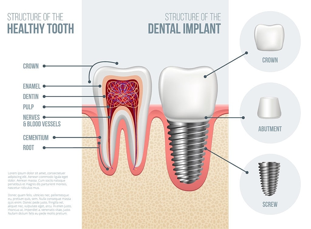 Are You a Candidate for Surgical Dental Implants?