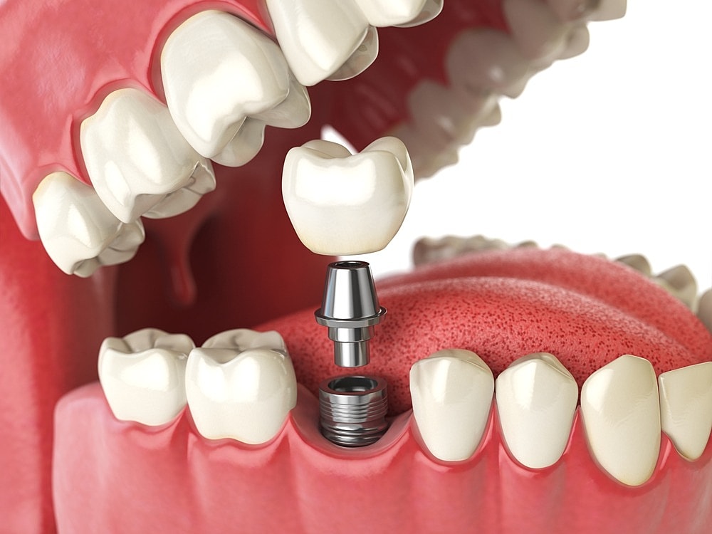 Dental Implant Bone Grafting and Growth