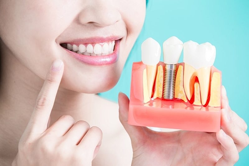Dental Implants: Improving Your Quality Of Life