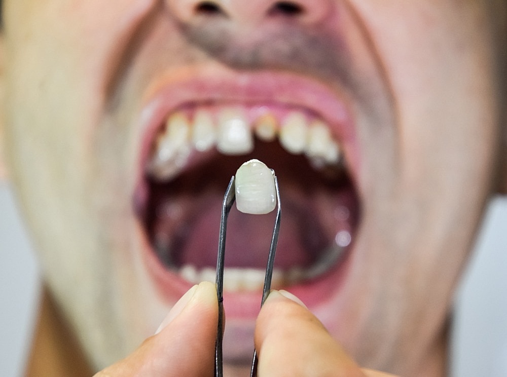 How Important Is Prompt Tooth Replacement?