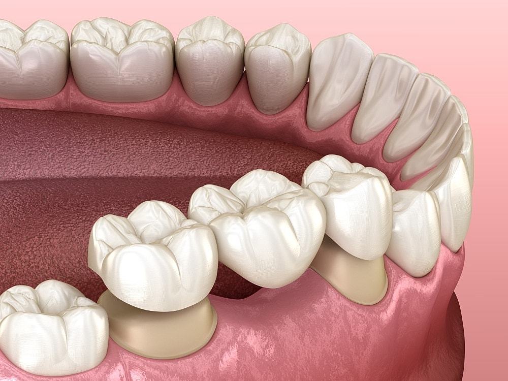 Impress Your Valentine's Date With Dental Crowns