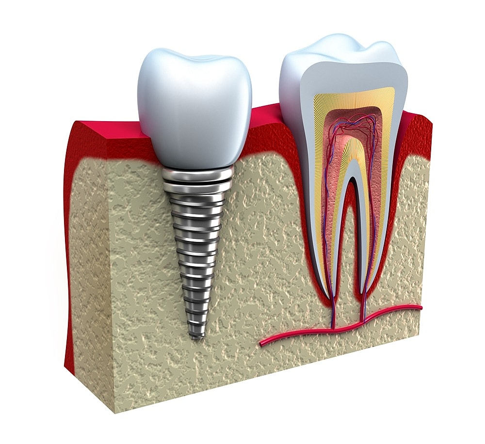 What to Expect When Getting Dental Implants