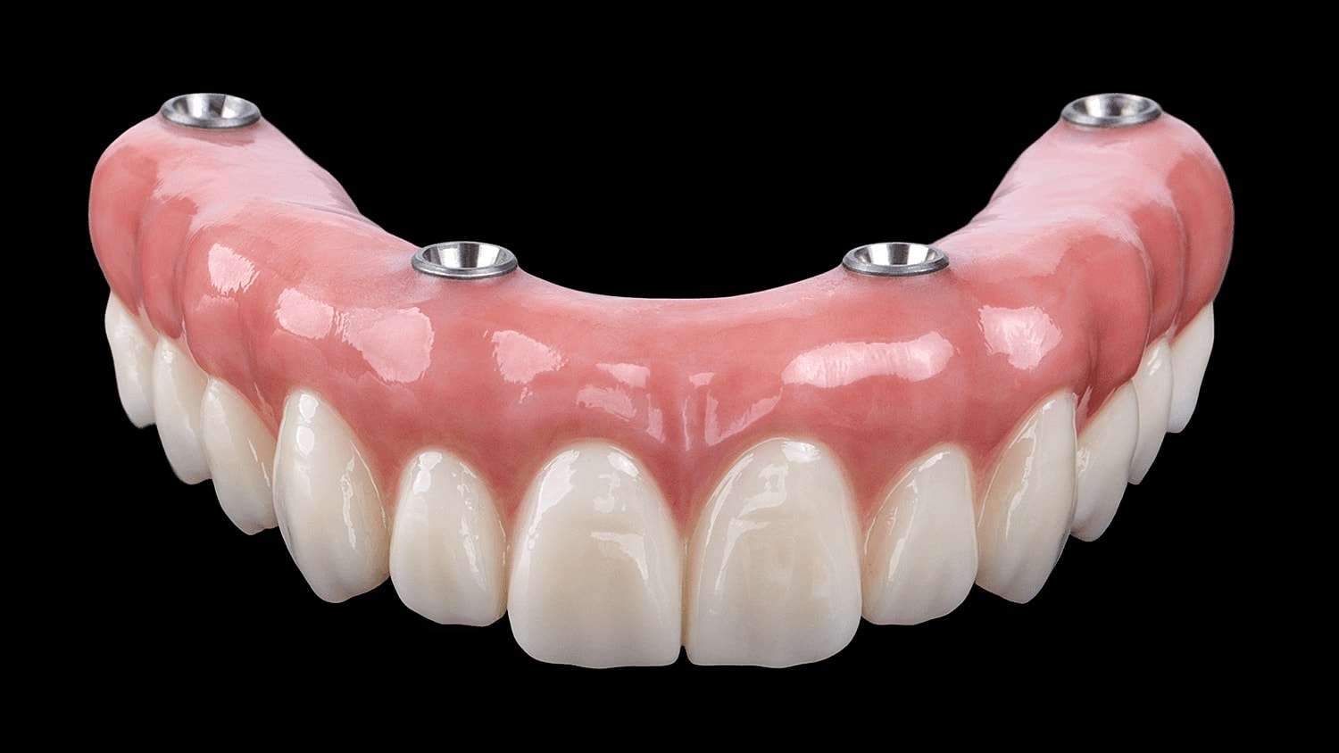 Dental prosthesis with implants and natural appearance.