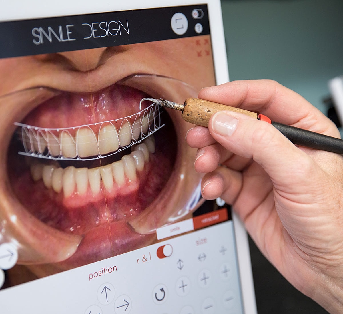 Digital dental design and customization process.