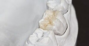 Model of dental teeth and filling detail.