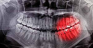 Dental X-ray showing impacted tooth highlighted in red.