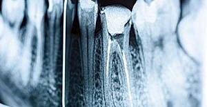 Dental X-ray displaying tooth structures and roots