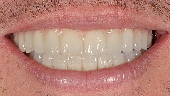 Dental Implants Before & After