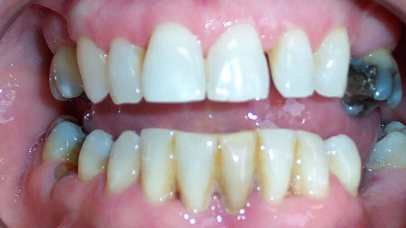 Dental Implants Before & After