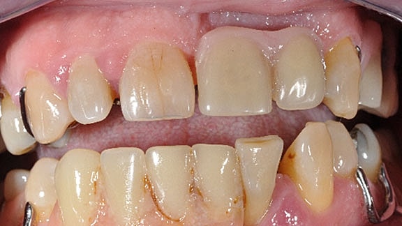 Dental Implants Before & After