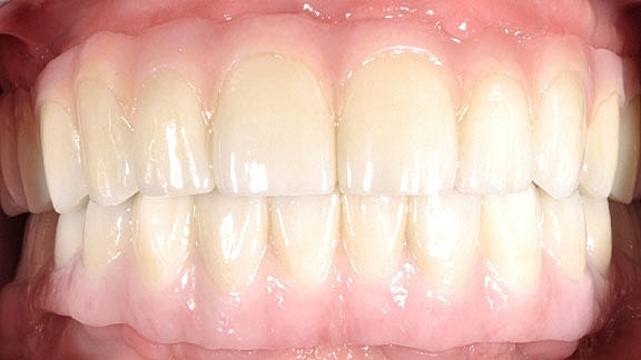 Dental Implants Before & After