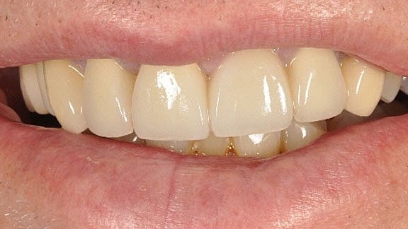 Dental Implants Before & After