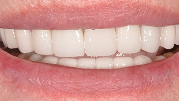 Dental Implants Before & After