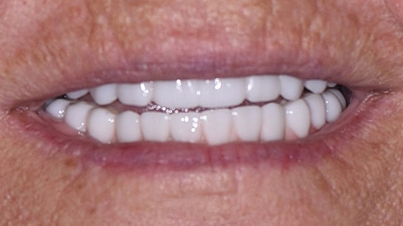 Dental Implants Before & After