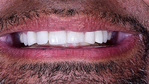 Dental Implants Before & After