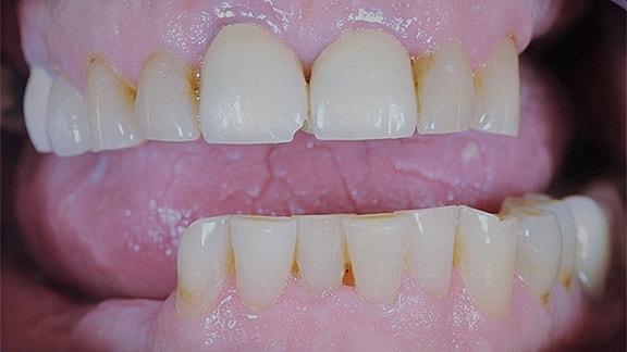 All On 4 Before & After