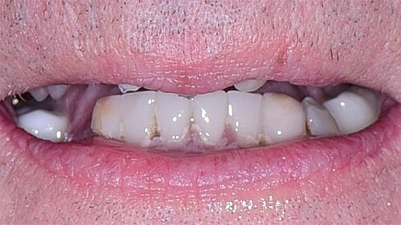 All On 4 Before & After