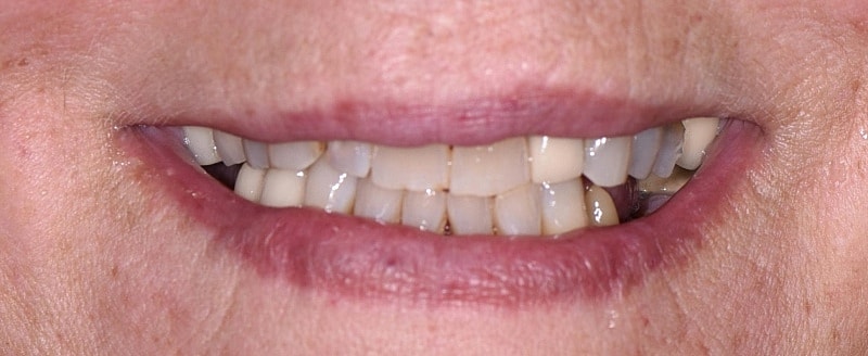 All On 4 Before & After