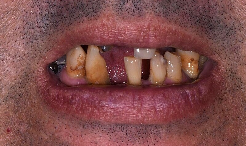 All On 4 Before & After