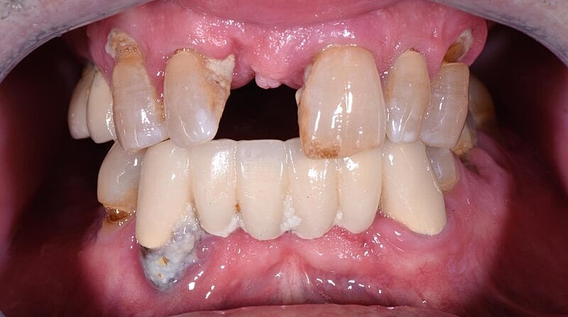 All On 4 Before & After