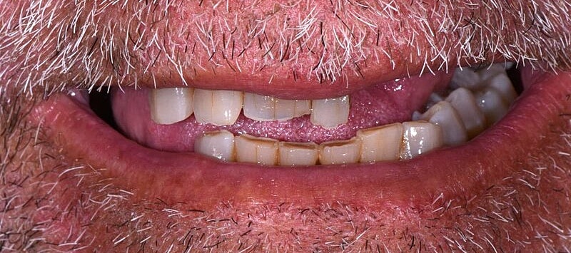 All On 4 Before & After