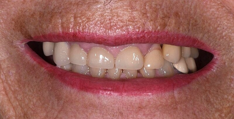 All On 4 Before & After