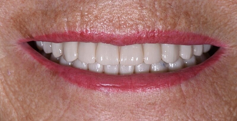 All On 4 Before & After