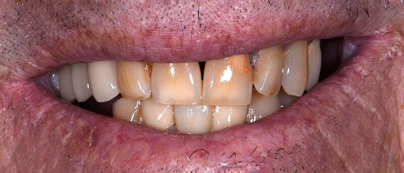 All On 4 Before & After