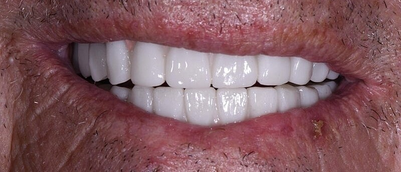 All On 4 Before & After