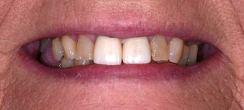 All On 4 Before & After