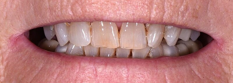 All On 4 Before & After