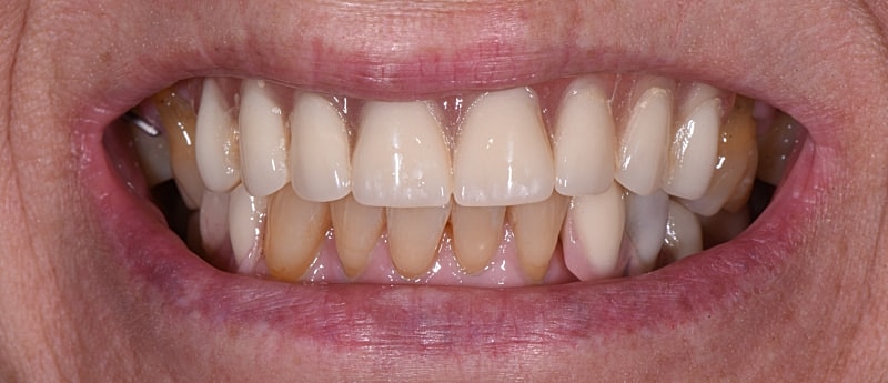 All On 4 Before & After