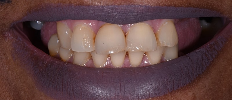 All On 4 Before & After