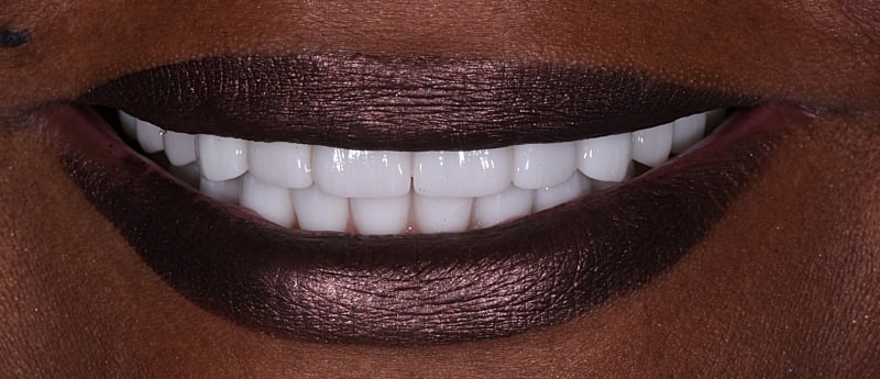 All On 4 Before & After