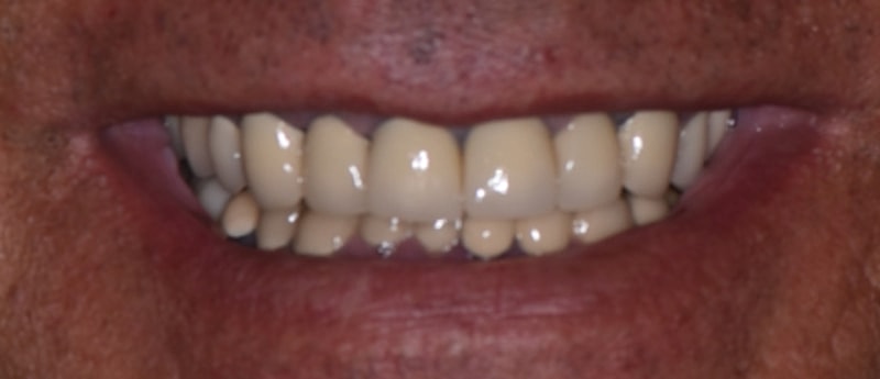 All On 4 Before & After