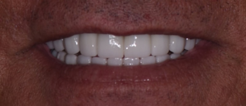 All On 4 Before & After