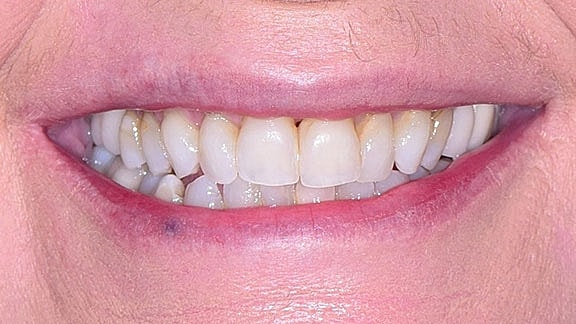Veneers Before & After