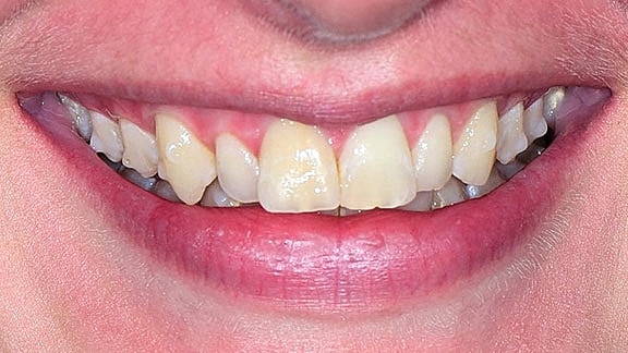 Veneers Before & After