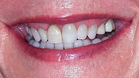 Veneers Before & After