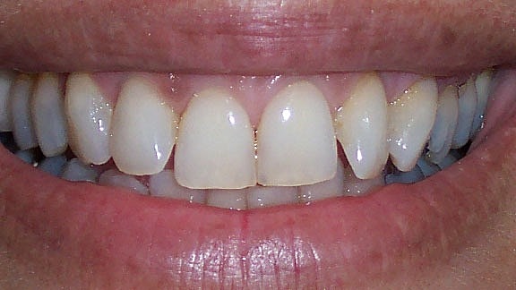 Veneers Before & After