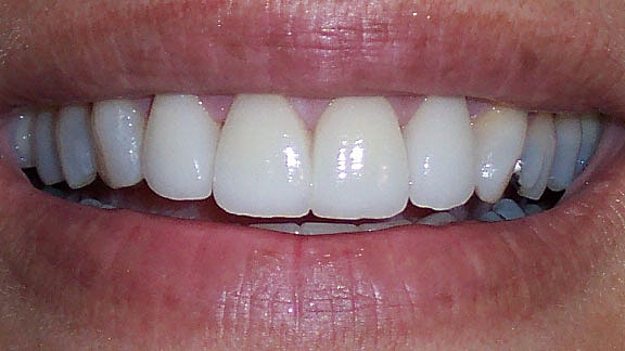 Veneers Before & After