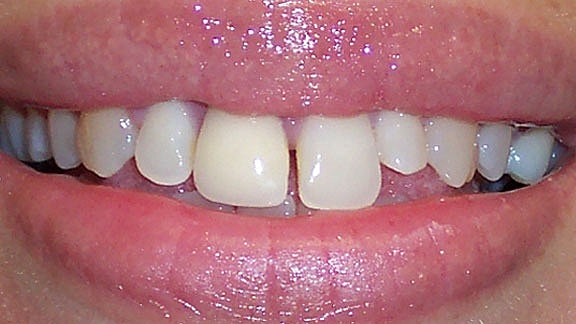 Veneers Before & After