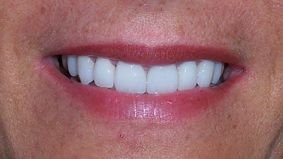 Veneers Before & After