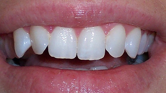 Veneers Before & After