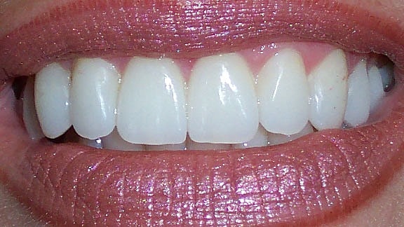 Veneers Before & After