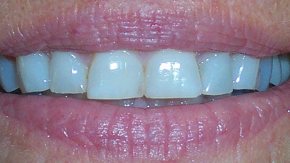 Veneers Before & After