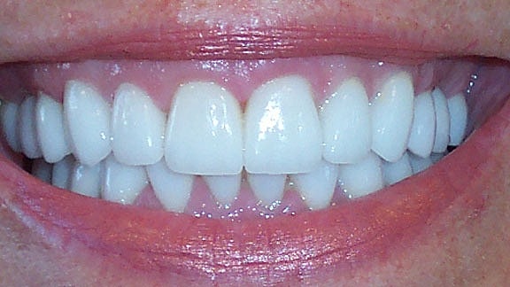 Veneers Before & After