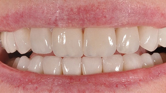 Veneers Before & After