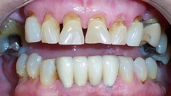 Veneers Before & After