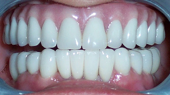 Veneers Before & After